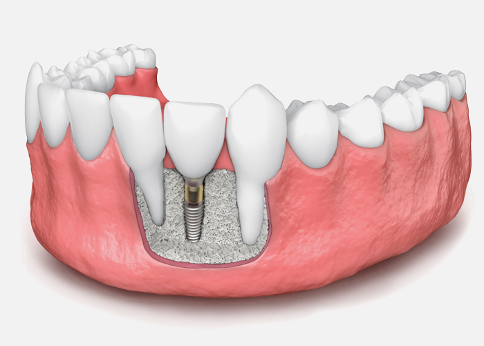 Bone Grafting Why It’s Needed and How It Works My Dentist Toluca Lake