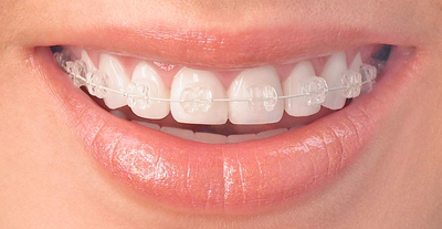 Invisalign or Ceramic Braces?