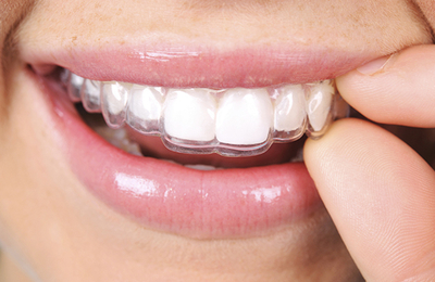 Braces Burbank: Metal, Ceramic, Invisalign