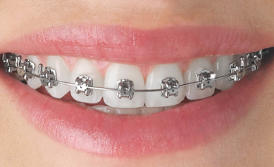 Invisalign or Ceramic Braces?