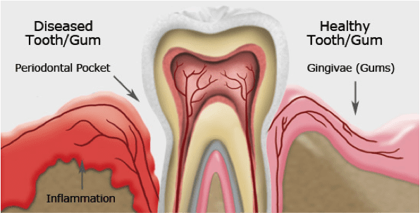 healthy tooth/gum vs diseased tooth/gum