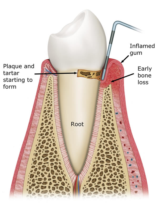 periodontal desease illustration
