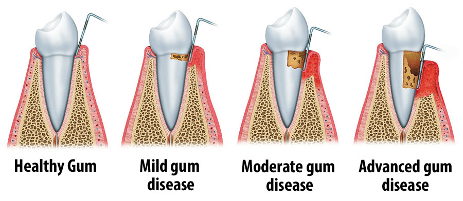 gum desease in stages