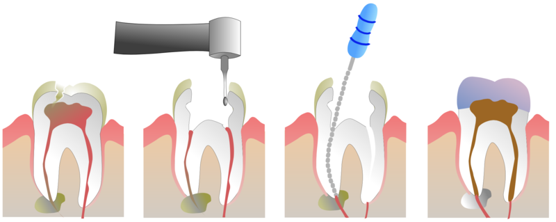 root canal tretment steps