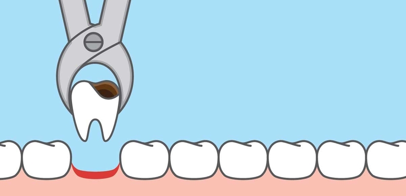 tooth removal reasons