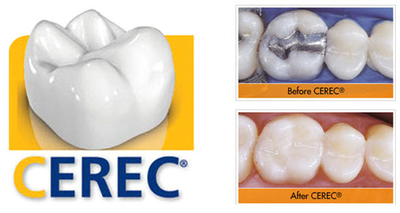 cerec crown