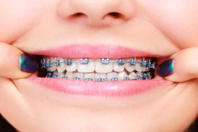 traditional braces