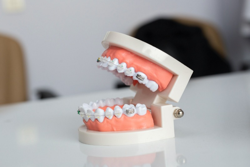 How Do Braces Actually Straighten Teeth?