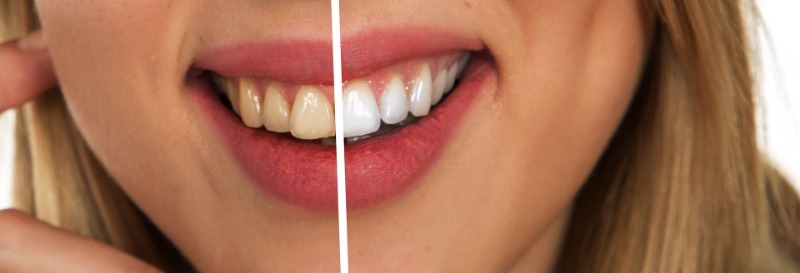 teeth whitening