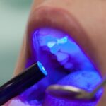 whitening
